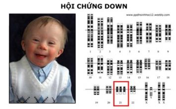 Dị tật bẩm sinh ở thai nhi và nguyên nhân
