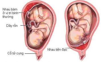 Nhau tiền đạo là gì ? 
