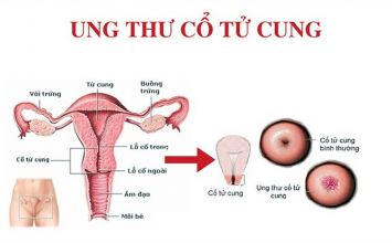 dấu hiệu ung thư cổ tử cung giai đoạn đầu