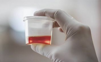 hồng cầu niệu