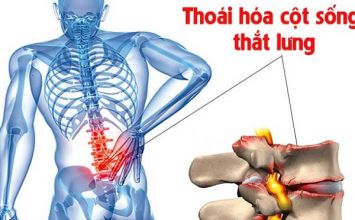 thoái hóa cột sống thắt lưng