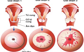 ung thư cổ tử cung 