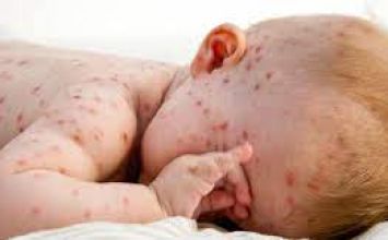 các bệnh truyền nhiễm từ mẹ sang con