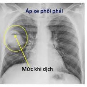Chụp X-quang phổi: Chụp X-quang phổi là một phương pháp xác định tình trạng sức khỏe của phổi rất quan trọng. Hình ảnh này sẽ giúp bạn hiểu rõ hơn về quá trình chụp X-quang và giải thích những gì mà các bác sĩ sẽ tìm thấy trên hình ảnh. Điều này có thể giúp bạn đưa ra các quyết định chính xác hơn về sức khỏe của mình.