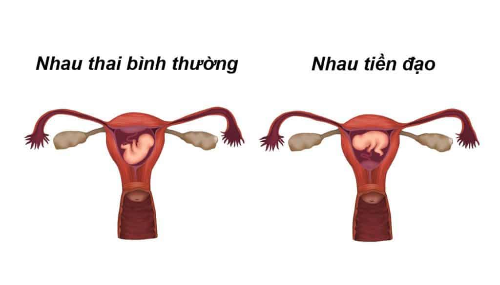 Nhau tiền đạo