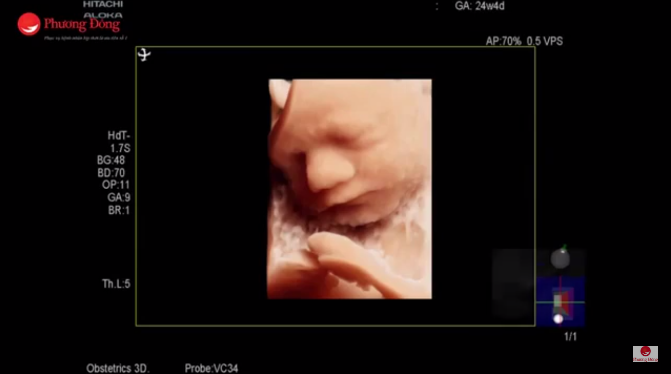 Hình ảnh siêu âm thai nhi từ máy siêu âm 4D Hitachi ARIETTA S60