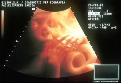 Khám phá giới tính của thai nhi của bạn cùng với hình ảnh sinh động và chân thực từ Siêu âm thai 4D. Điều này sẽ giúp các bà mẹ sẵn sàng cho những ngày tới và cảm thấy yên tâm hơn khi chuẩn bị cho công cuộc chăm sóc cho em bé của mình.