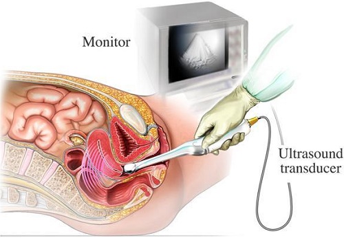 Bệnh lạc nội mạc tử cung và Chẩn đoán hình ảnh  Bệnh Viện Đa Khoa Tỉnh Lào  Cai