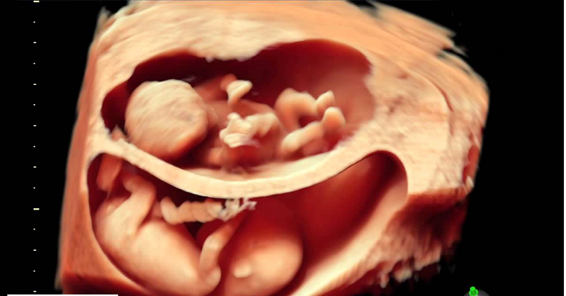 Siêu âm Doppler mạch máu thai nhi: Bức ảnh vô cùng độc đáo với chức năng siêu âm Doppler mạch máu thai nhi giúp đo lường lưu lượng máu đi đến thai nhi. Đây là công nghệ mới giúp phát hiện các vấn đề sức khỏe ở thai kì để đảm bảo sự an toàn cho mẹ và bé. Hãy cùng theo dõi bức ảnh này và khám phá những thông tin mới nhất về thai nhi.