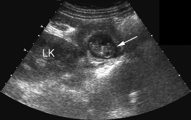 На узи видно внематочную. Внематочная беременность на УЗИ. УЗИ при внематочной беременности. Трубная беременность УЗИ.