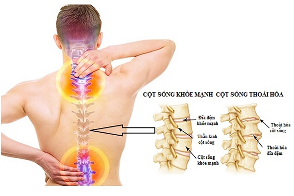 Thoái Hóa Cột Sống Thắt Lưng Là Gì? Nguyên Nhân, Triệu Chứng Và Cách Điều Trị Hiệu Quả