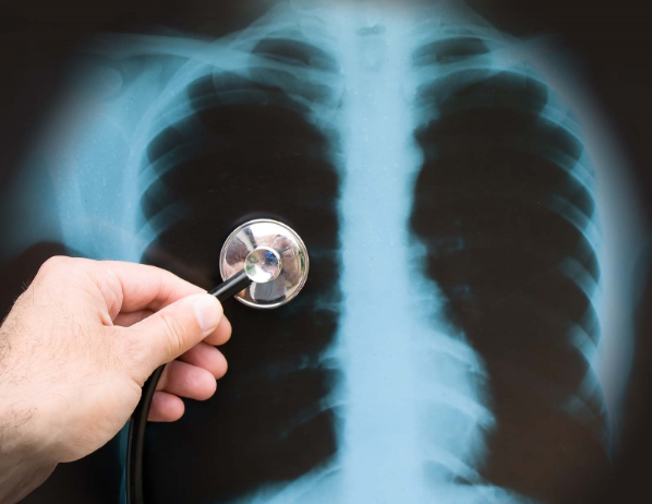 Những bệnh lý có thể phát hiện qua chụp X-quang phổi